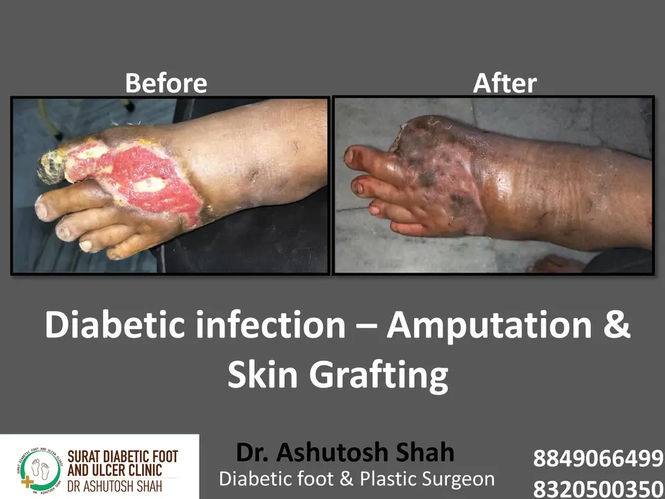 Diabetic Foot  PPT 3 checked by sir.pptx-92.webp